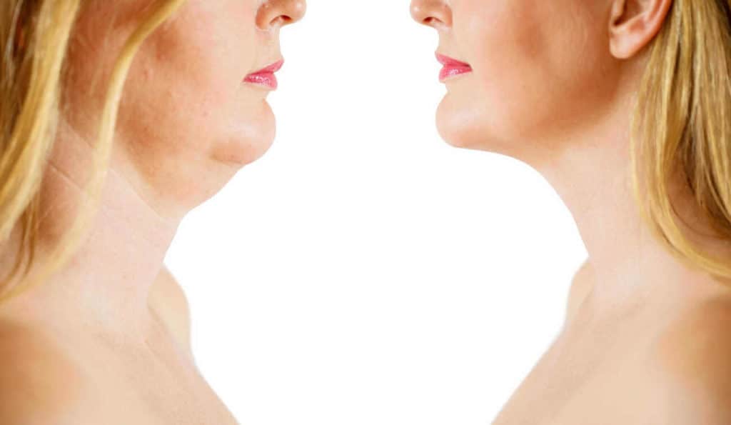 Double Chin treatment Plaistow before and after results
