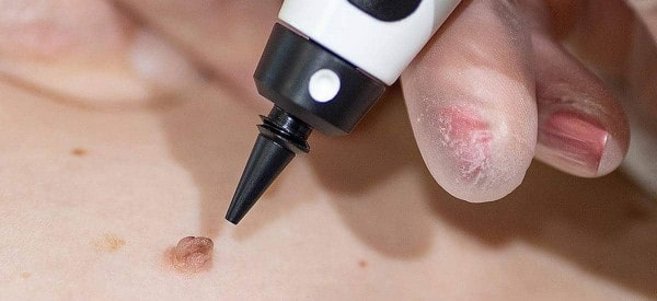 After Skin Tag Removal Plaistow