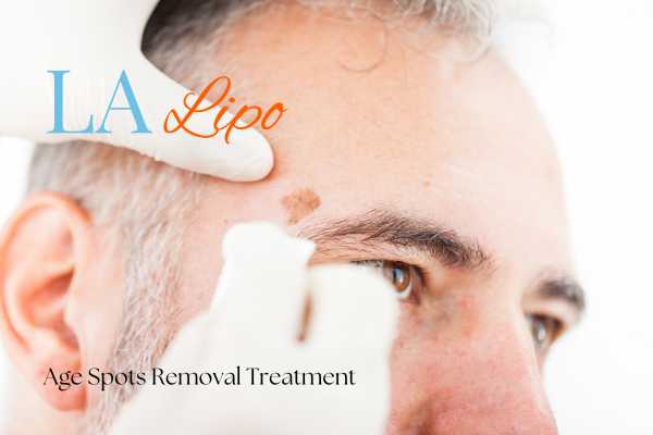 What Are the Most Effective Treatments for Age Spots Plaistow?