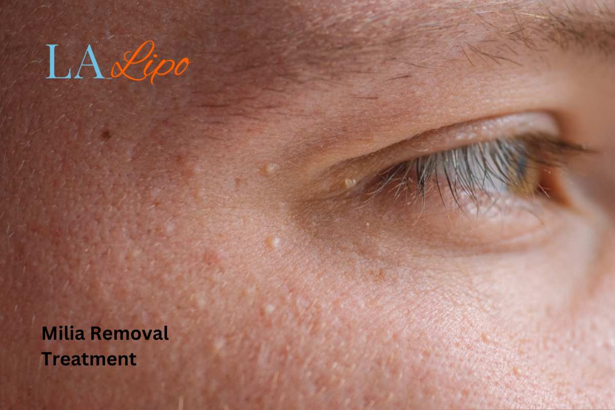 Cryopen Milia Removal: Is It the Easiest and Safest Option Plaistow?
