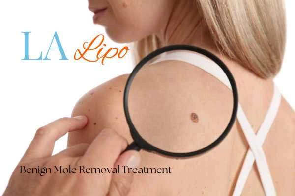 Why getting moles removed Plaistow can boost your confidence!