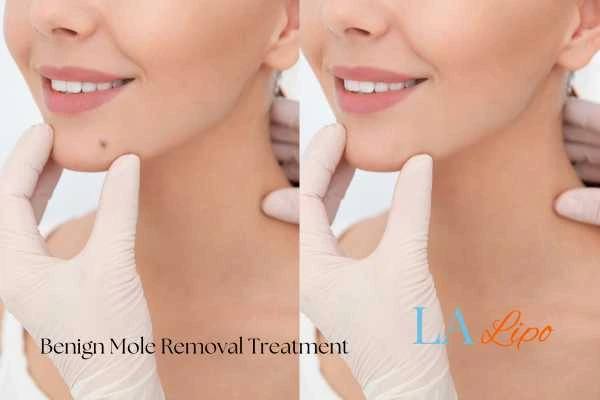 Woman's before and after results of being moles removal treatment Plaistow