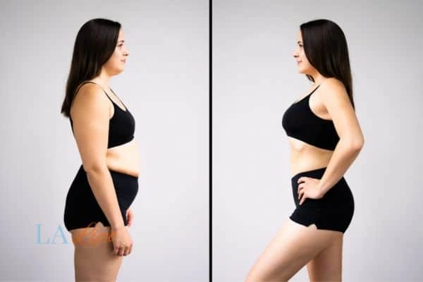 image of woman before and after results of LA-EMS Body Sculpting Plaistow to help treat Diastasis recti