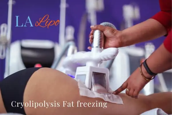 women getting fat freezing Plaistow