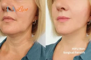 hi-fu for wrinkles Plaistow before and after results