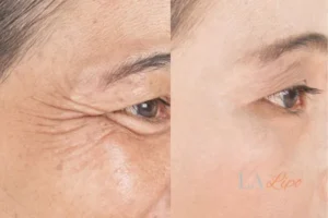 Before and after results of woman - HI-fu wrinkles reduction treatment Plaistow