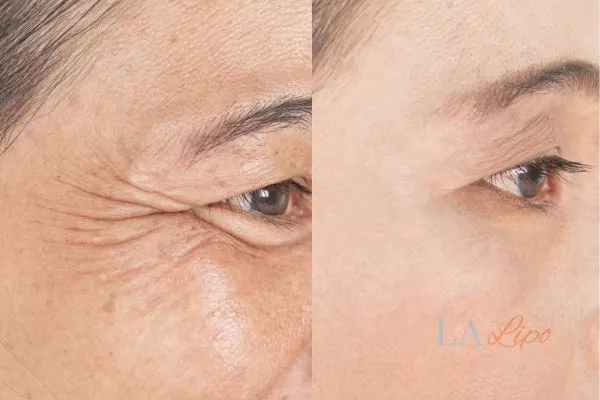 Before and after results of woman - HI-fu wrinkles reduction treatment Plaistow