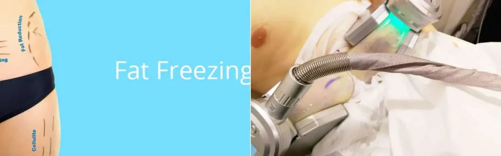 multi areas of a persons body having coolsculpting Plaistow treatment