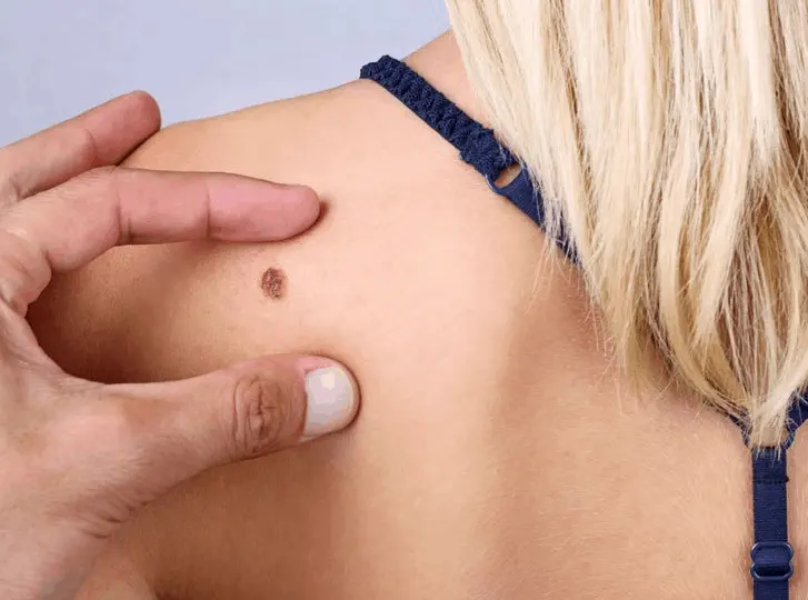 woman having mole removal Plaistow consultation before treatment.