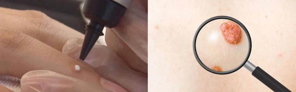 Person getting moles removed with cryopen Plaistow