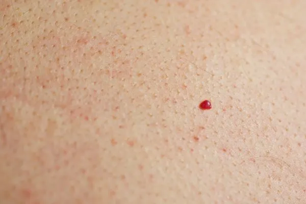close up of a cherry angioma Plaistow