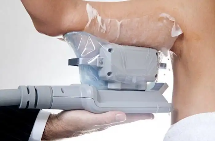Picture of fat freezing Plaistow on the upper arms.