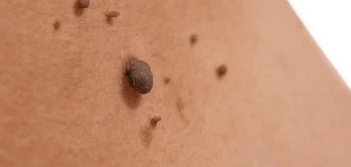 image of a skin tag Plaistow
