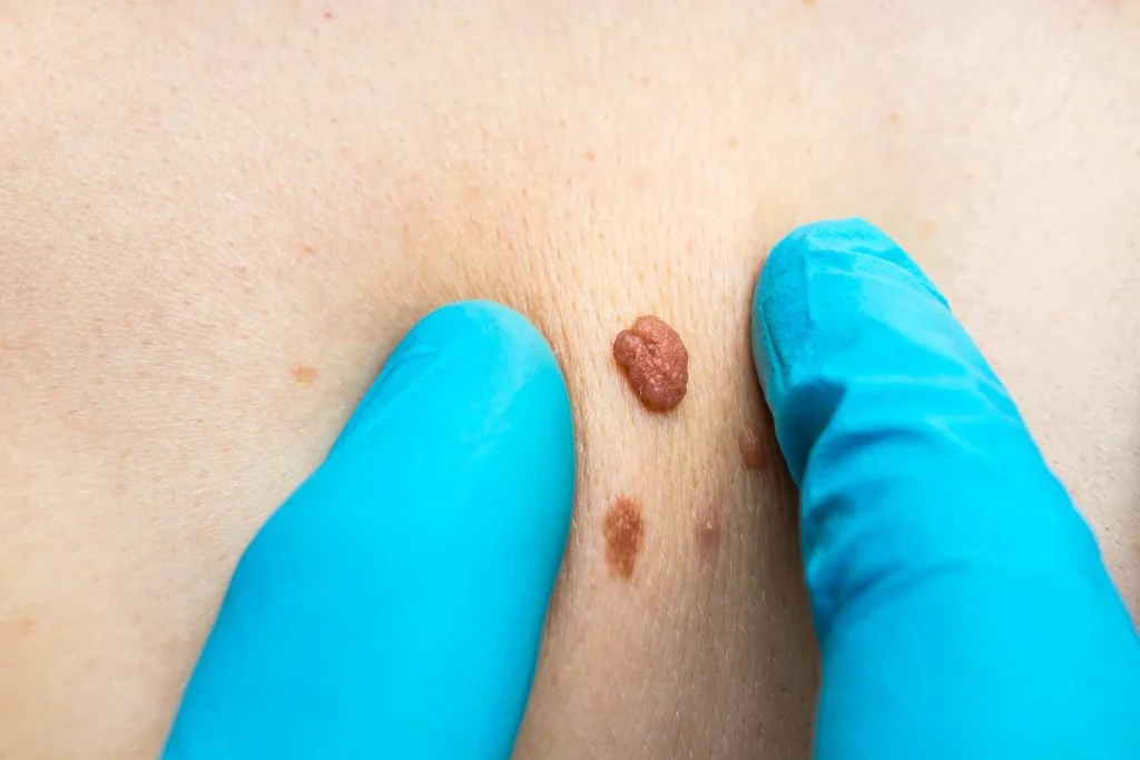 Consultant examining a skin tag Plaistow