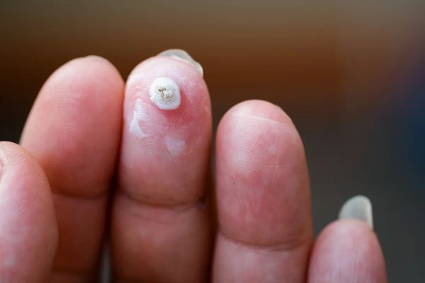 wart on person finger - cryotherapy to treat from LA LIPO Plaistow