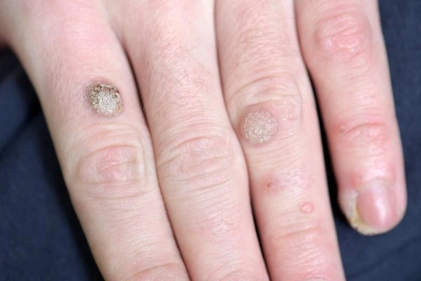 photo of warts on person hand - see wart removal Plaistow from LA LIPO