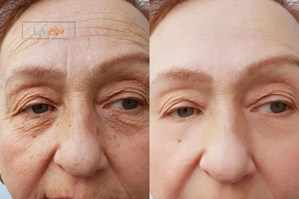 The powerful benefits of Morpheus8 Treatment Plaistow - Call Our team today!
