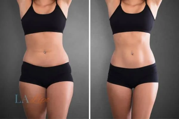 before and after results of non-surgical treatment to help a woman's body image and mental health Plaistow