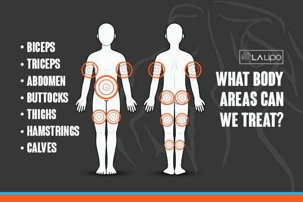 Diagram to show areas you can have LA-EMS Body Sculpting Treatment Plaistow