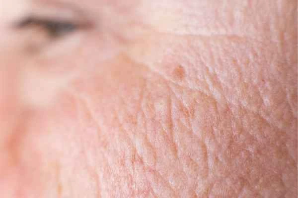 close up picture of a woman's face showing an age spot Plaistow