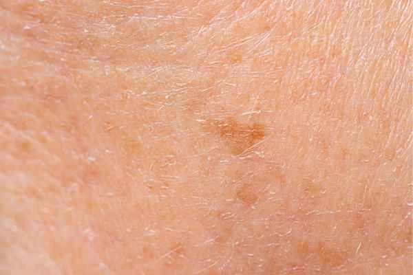 close up picture of age spots Plaistow