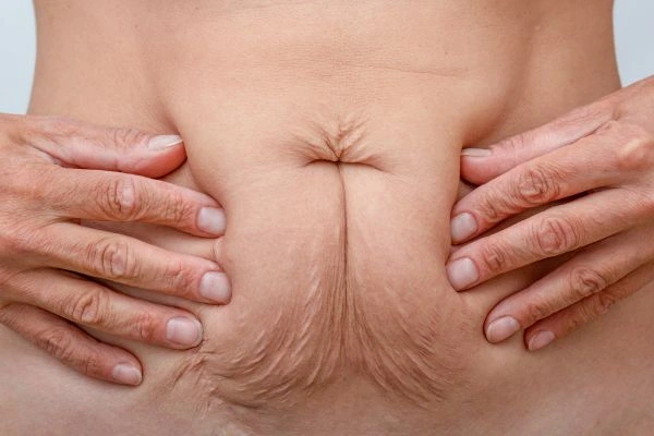 Image of a woman's stomach with loose skin - example of skin tightening Plaistow options