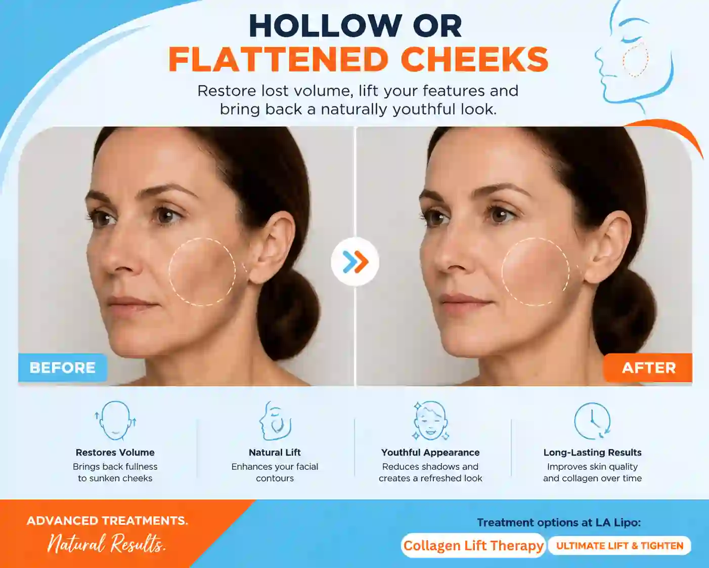 Sign #4: Hollow or Flattened Cheeks Plaistow